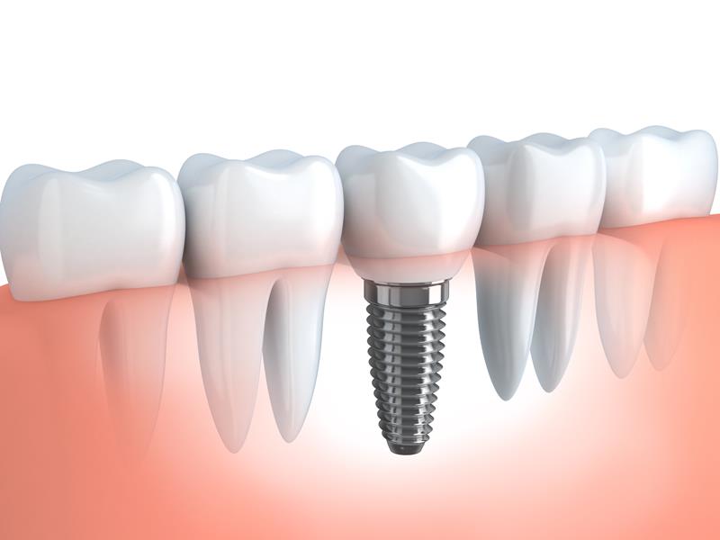 Dental Implants  Coquitlam, BC VE J